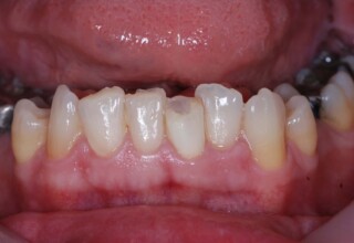 Root canal lower central with a slightly darker appearance and significantly shorter than adjacent teeth due to labial position and high overlap.