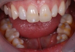 Stained vital central incisors and generalized “dark” teeth.