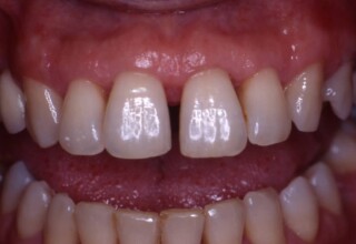 Diastema between upper central incisors due to migration as a consequence of neglected periodontitis.