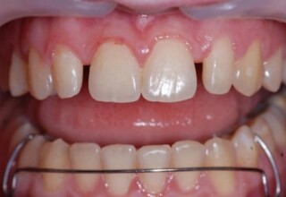 Diastemas between lateral and central incisors after orthodontic treatment