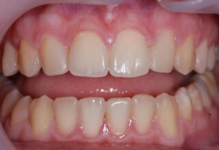 Diastemas restored with composite (resin) restorations