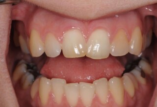 Significant improvement of the teeth brightness.