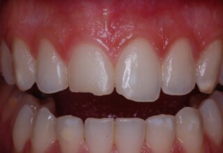 Chipped upper central incisors.