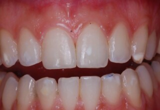 Restored with composite resin.