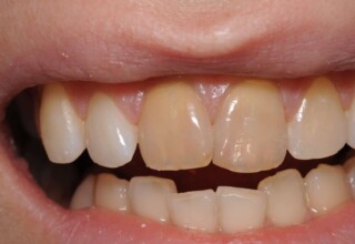 Dark upper central incisors with a root canal.