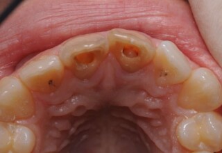 Palatal view after the removal of old restorations.