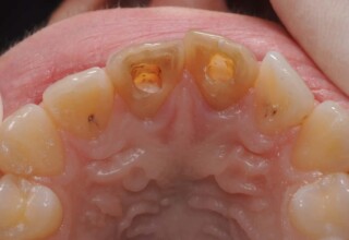 Placement of the intraradicular filling.
