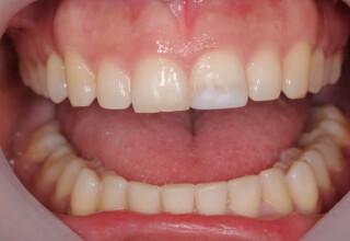 Unesthetic restoration on the upper left incisor.