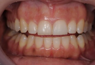 New composite restoration with the appropriate size and shade.