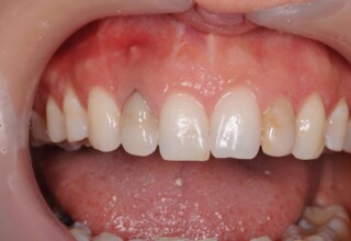 Dark upper right lateral incisor with a root canal.