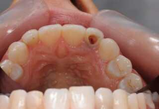 Removal of old materials and restorations from the internal tooth chamber.