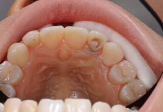 Placement of the intraradicular filling.