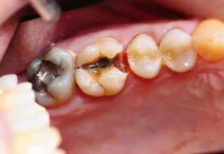 The upper left first molar with an old amalgam removed presents with a hair line fracture across the whole mesio-distal dimension of the tooth.
