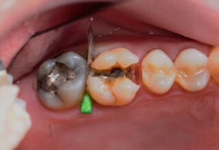 Extension of the preparation to include the full length of the crack.