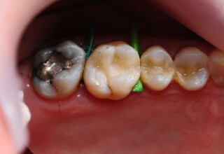 Composite adhesive restoration finalized. Provision of occlusal contact points on the filling to protect the remaining tooth structure from tension forces.