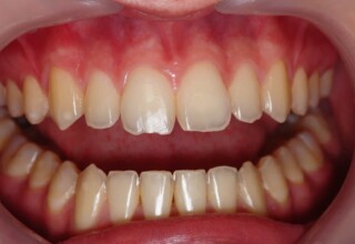 Central incisor with a chipped incisal edge due to an accident.