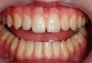 Composite restoration that efficiently restores missing tooth structure and provides the local optical effects of the incisal edge (translucency and brightness).