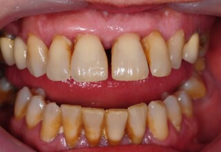 Fifteen year follow-up. Restorations in excellent condition but poor periodontal care and recurrent periodontitis have led to further incisor migration and diastema development.
