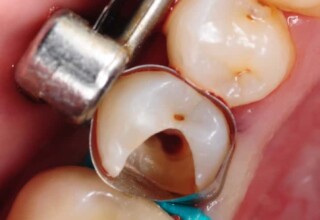 Lower second premolar after the root canal and immediately before restoration. Matrix band and wedge placed to form the missing surface.