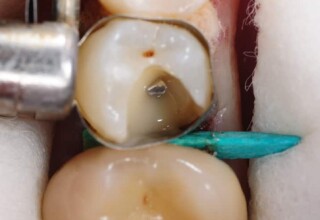Prefabricated metal post cemented in the root canal with a tooth colored resin cement.