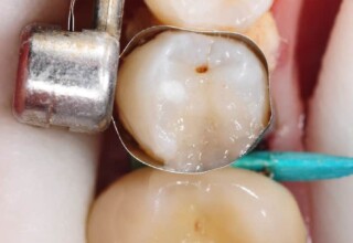 Composite resin added to provide slightly overcontoured restoration.