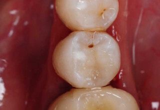 Finalized restoration after necessary adjustments and polishing.