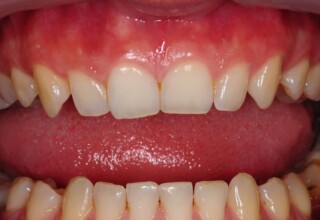 Acute shaped upper canines.