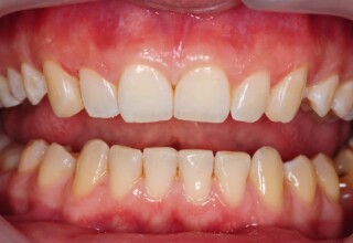 Dramatically “softened” patients smile. Reshaped canines with selective composite resin addition without hard tissue removal.
