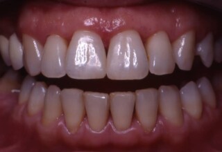 Diastema closure with composite resin material.