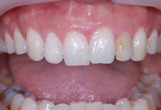 Restoration of bleached upper right lateral.