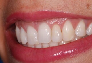 Replacement of the restoration of upper left lateral incisor.
