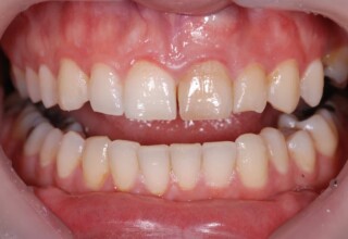 Dyschromic upper left central and lateral incisor with root canals.