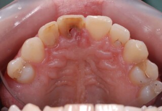 Palatal view of the central incisor with external absorption!
