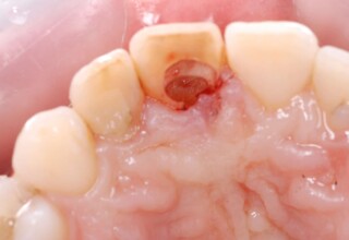 Central incisor debridement and preparation for initial restoration.