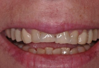 Old and chipped restorations on both upper central incisors.