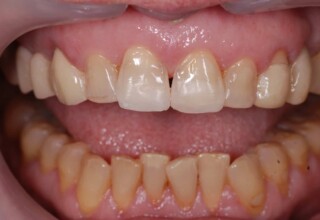 New composite restorations with the appropriate form and shade.