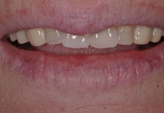 Smile improvement.