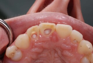 Initial restoration with space provision for bleaching of the central and preparation of the lateral incisor for concomitant bleaching.