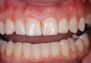 Final restorations