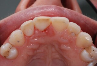 Palatal view of the central and lateral incisor restorations after bleaching.