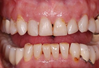 Staining, poor size and shape for both anterior and posterior teeth.