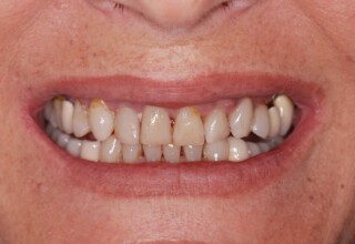 Unaesthetic appearance of upper anterior teeth
