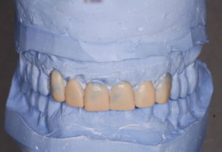 Articulated casts with diagnostic wax up to incorporate changes in the width, length and shape of the anterior teeth. Facial view.