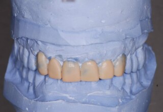 Articulated casts with diagnostic wax up to incorporate changes in the width, length and shape of the anterior teeth. Facial view.