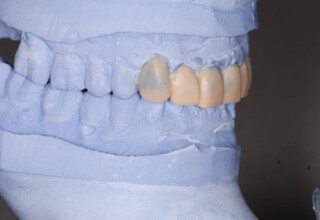 Articulated casts with diagnostic wax up. Lateral view.