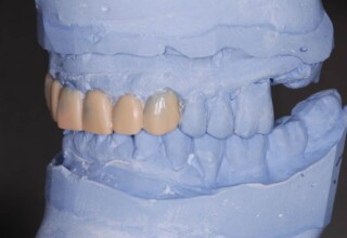 Articulated casts with diagnostic wax up. Lateral view.