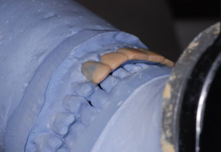 Palatal view of the estimated elongation to anterior teeth and their influence in lateral movements.