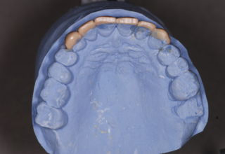 Palatal view of the estimated elongation to anterior teeth and their influence in lateral movements.