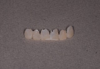 Resin cells for the fabrication of temporary veneers.