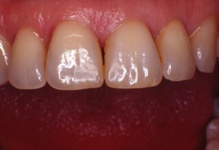 Five year follow-up. Restorations remain acceptable; require repolishing but periodontal care is diminishing.